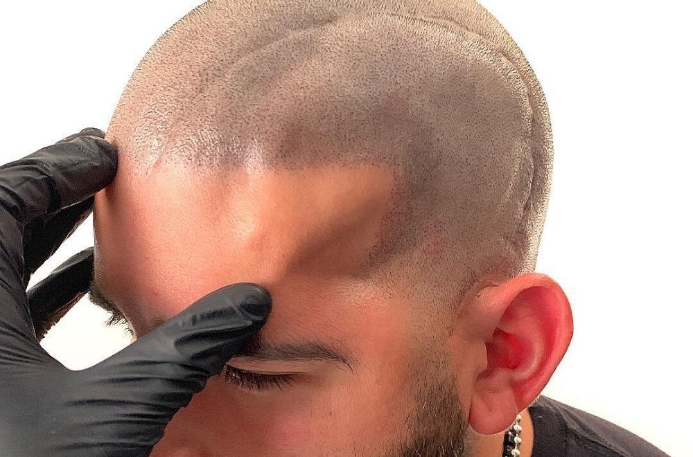 What Is Scalp Micropigmentation Elite Permanent Makeup