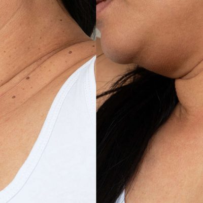 elite-Fibroblast-skin-tag-removal-before-and-after