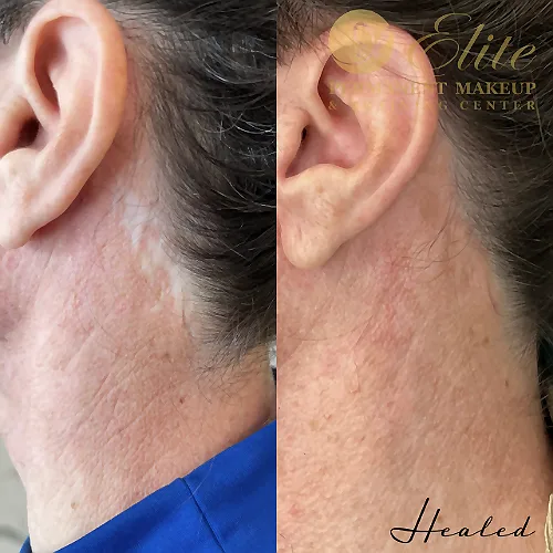 Camouflage Facelift Scars: Expert Solutions in Beverly Hills