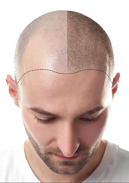 What Is Scalp Micropigmentation?