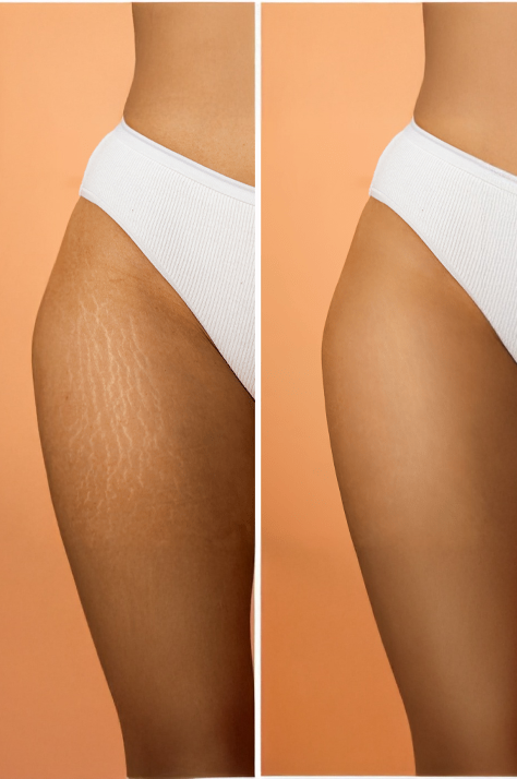 Hide Stretch Marks with Camouflage Techniques in Los Angeles