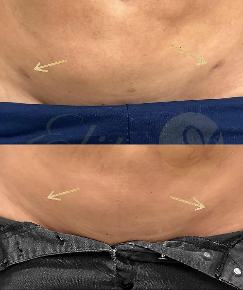 Tummy Tuck Scar Camouflage: Expert Solutions in West Los Angeles
