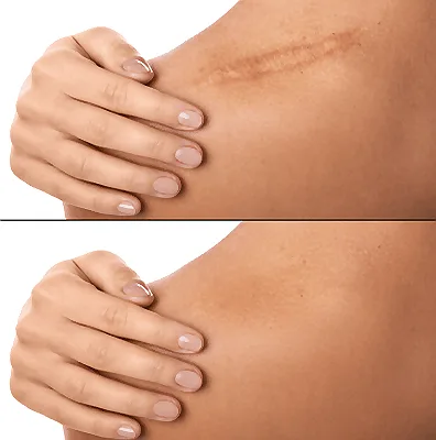 Camouflage Scars with Expert Solutions: Scar Camouflage in Beverly Hills