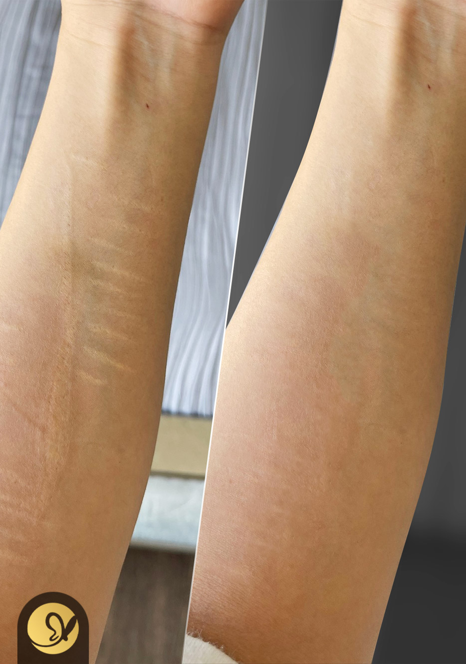 How Long Does Permanent Makeup for Scar Camouflage Last?