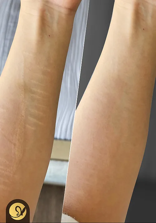 How Long Does Permanent Makeup for Scar Camouflage Last?