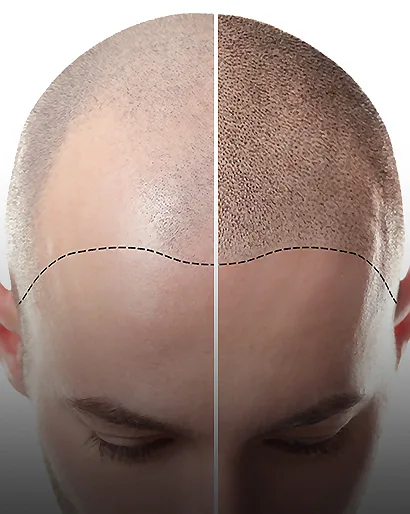 Scalp Micropigmentation