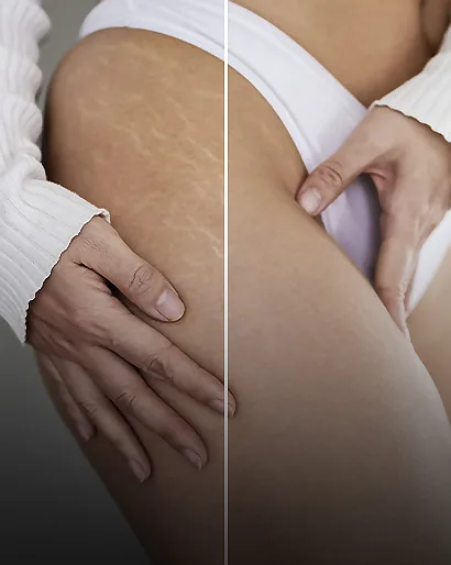 Inkless Stretch Marks